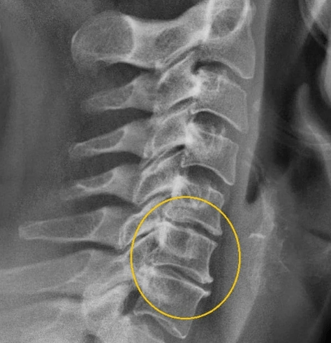 Osteochondroza szyjka macicy